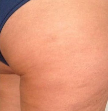 Nachher Cellulite