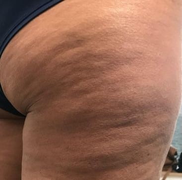 Vorher Cellulite