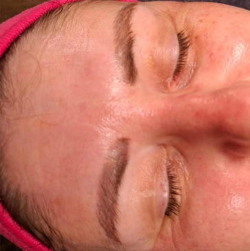 Nachher Hydrofacial